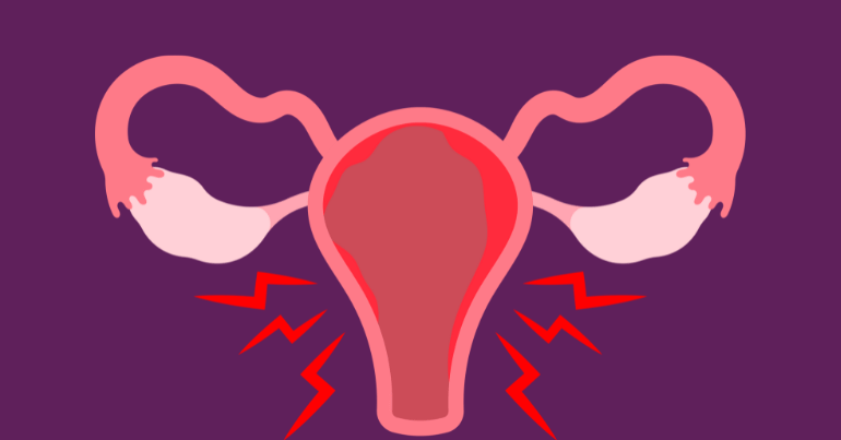 Endometriosis