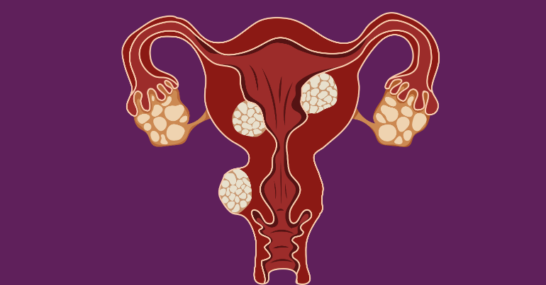 Fibroid Uterus