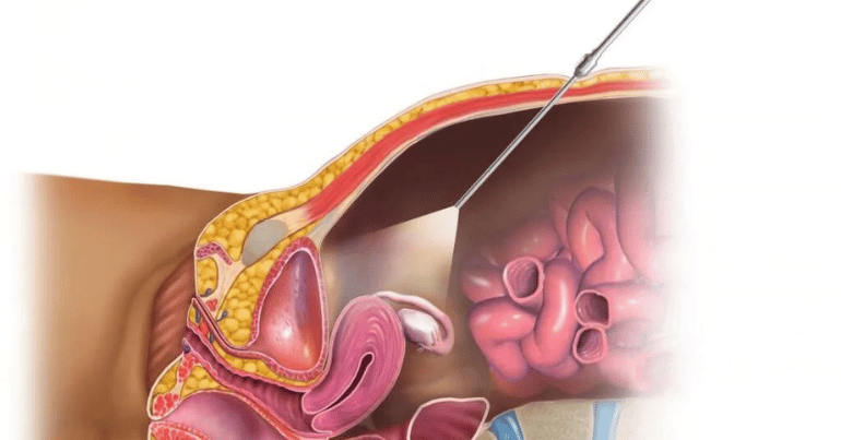 Laparoscopy Procedure