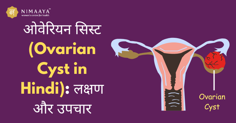 ओवेरियन सिस्ट (Ovarian Cyst in Hindi): लक्षण और उपचार