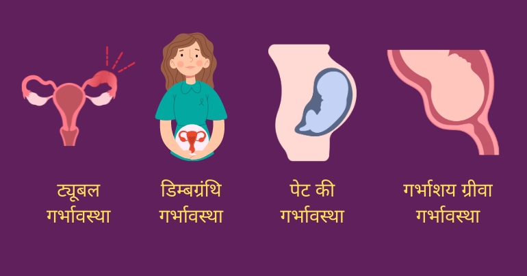 Types of Ectopic Pregnancy