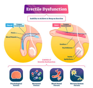 Erectile Dysfunction causes 