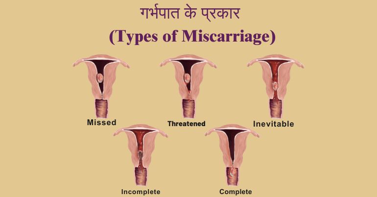 Types of Miscarriage